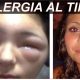 Alergia Al Tinte De Cabello
